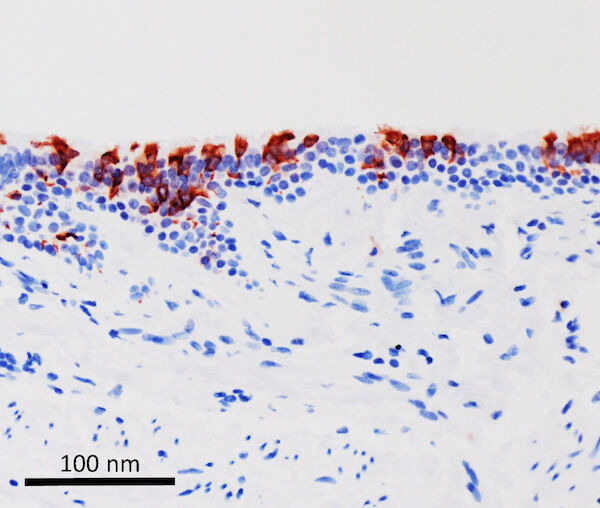 Die Omikron-Variante von SARS-CoV-2 (in rot) hat menschliches Bronchialgewebe infiziert. Die Omikron-Variante von SARS-CoV-2 (in rot) hat menschliches Bronchialgewebe infiziert.